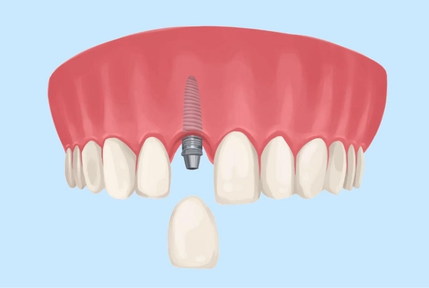 Front Tooth Implant