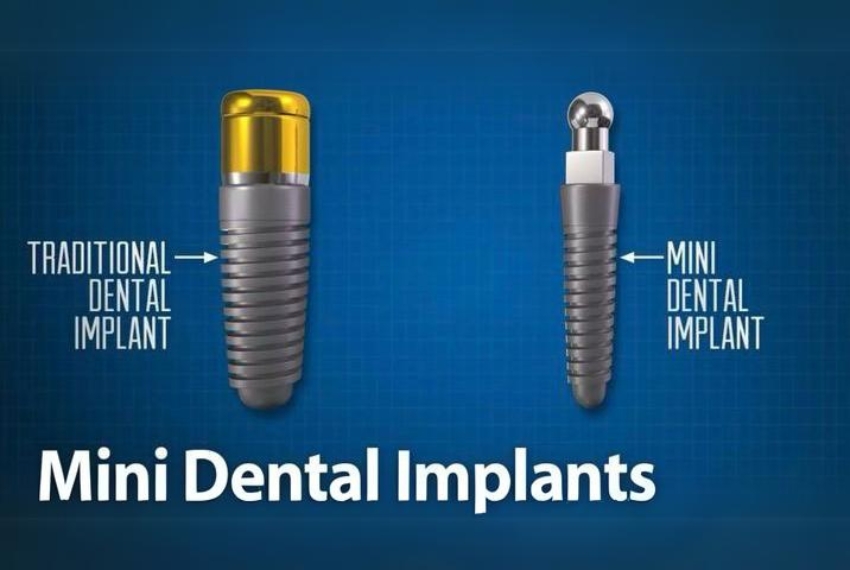 Mini Implant