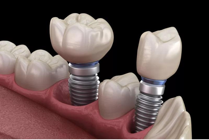 Titanium Implant