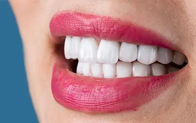 Зъбни коронки и фасети