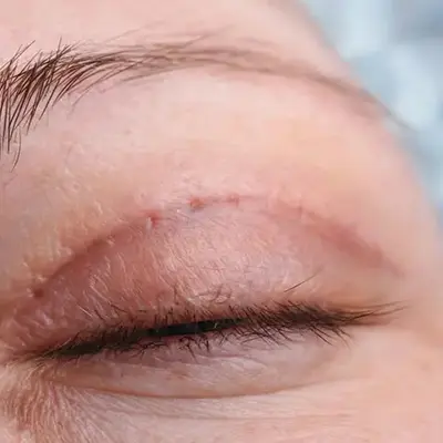 Блефаропластика