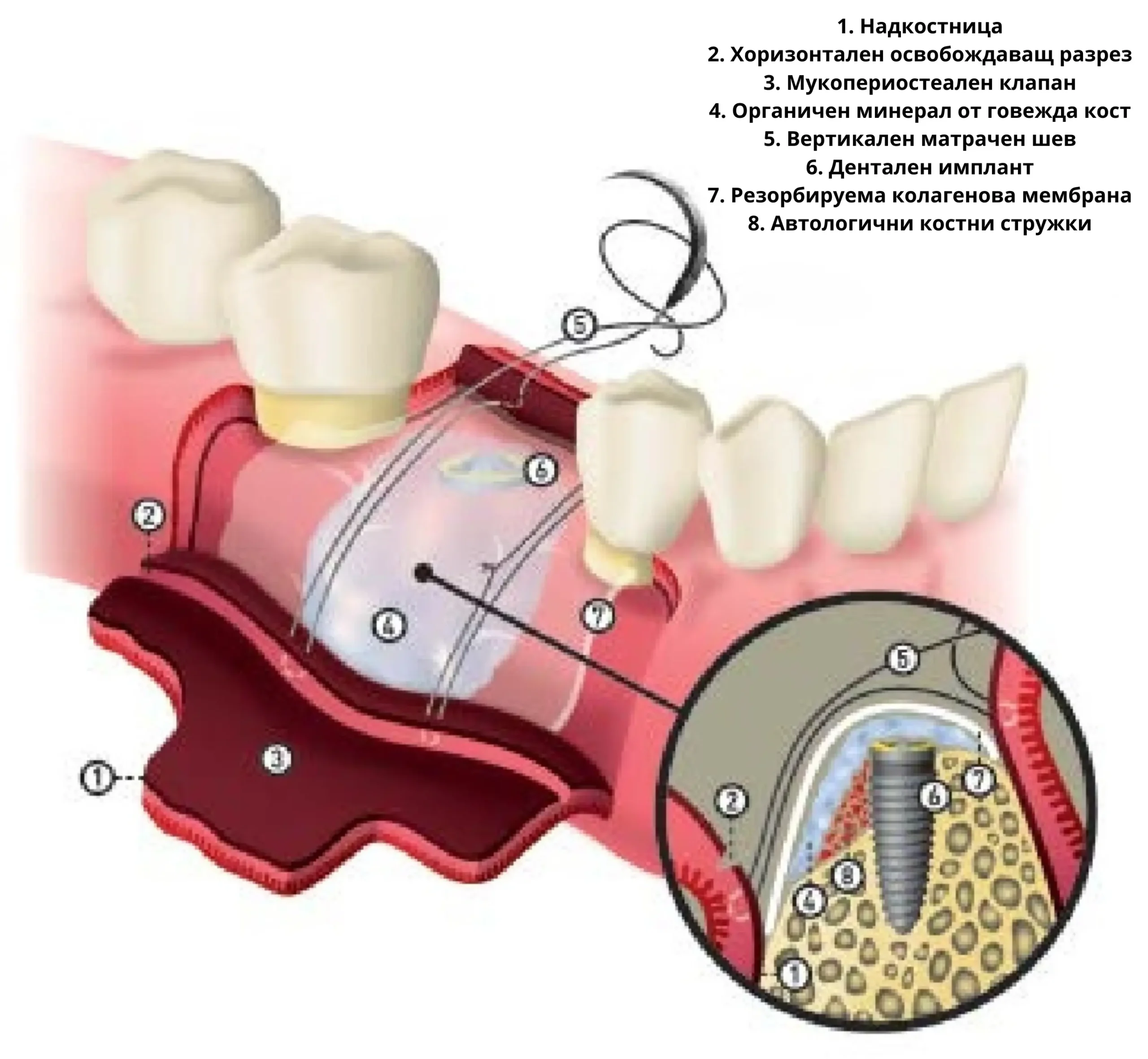 Операция Синус лифтинг