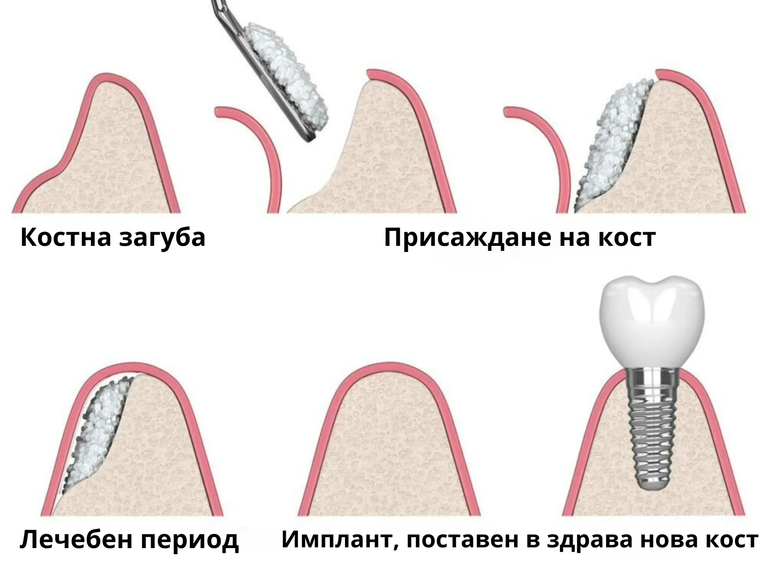 Операция Синус лифтинг