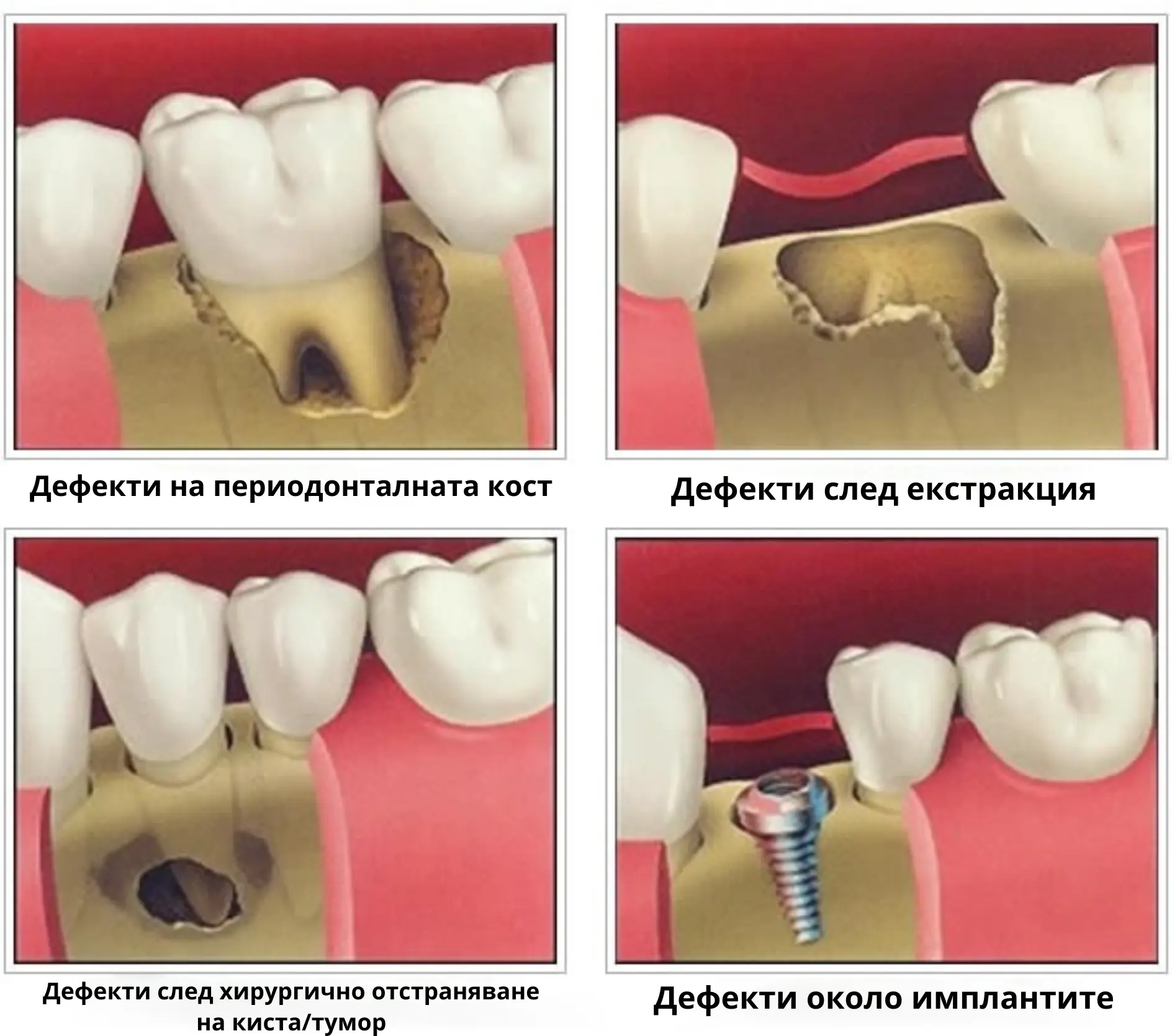 Операция Синус лифтинг