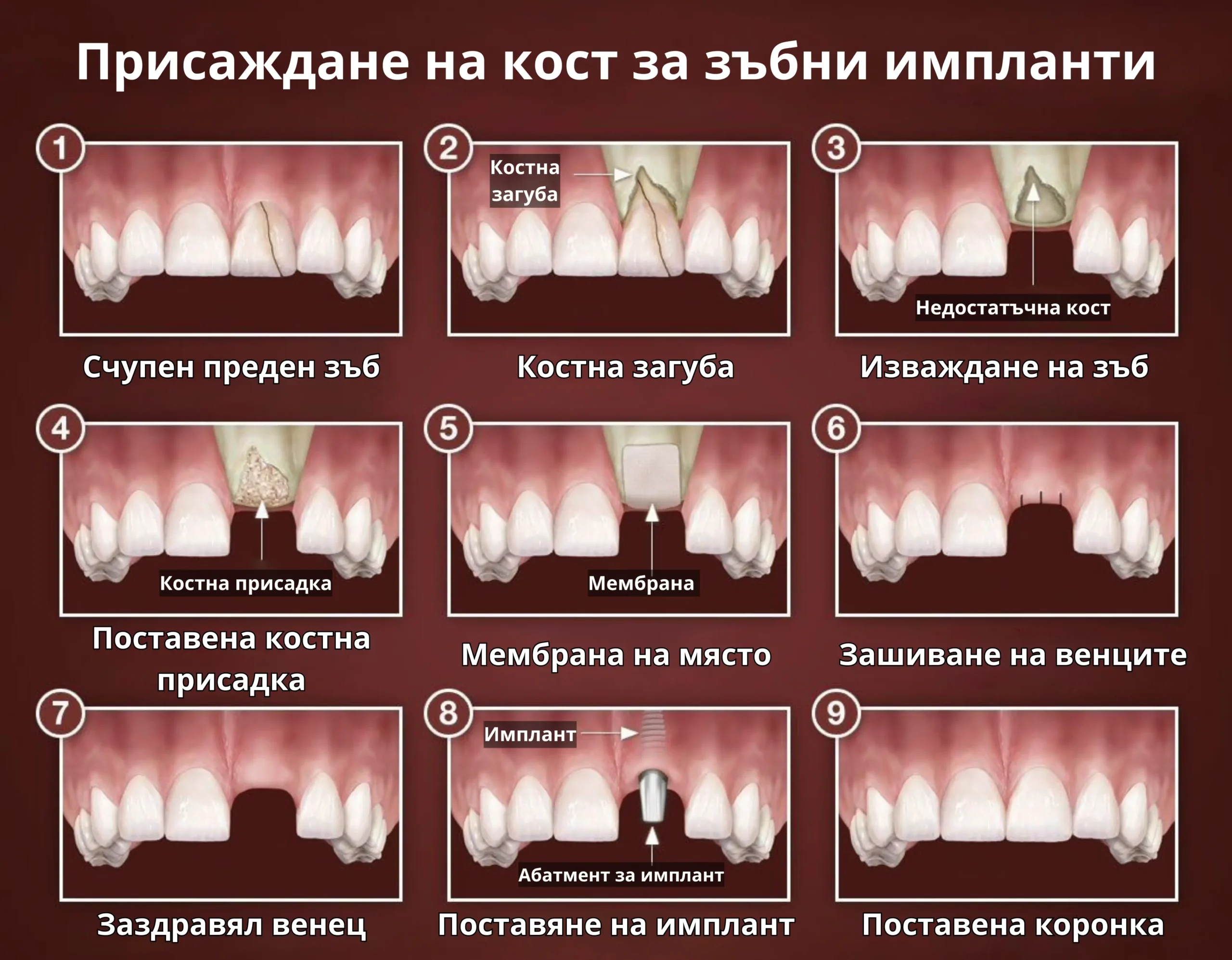 Операция Синус лифтинг